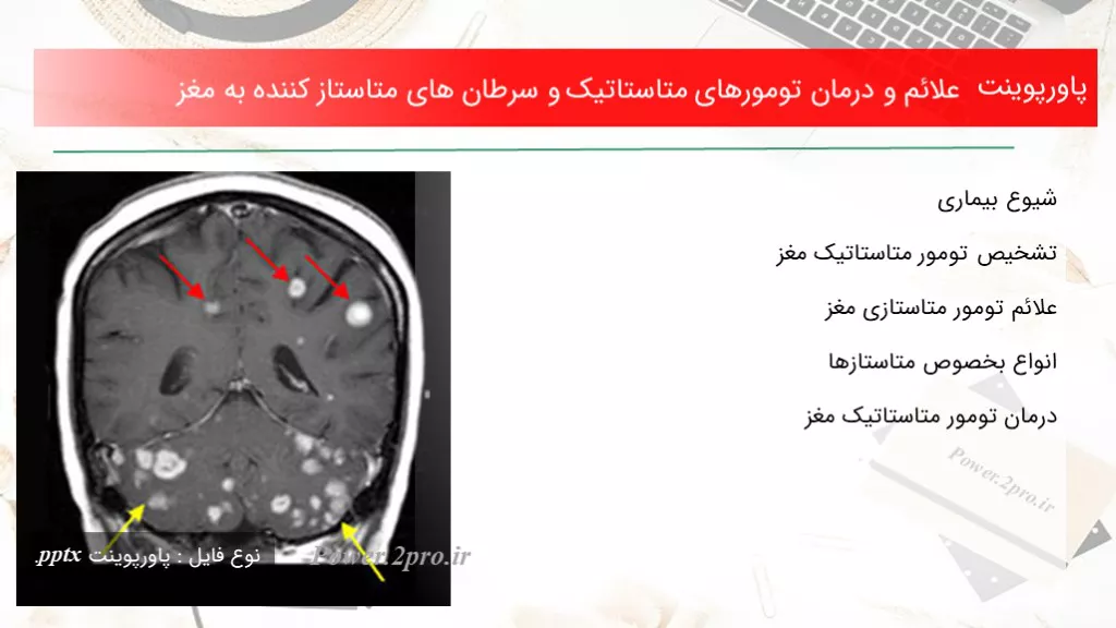 دانلود پاورپوینت علائم و درمان تومورهای متاستاتیک و سرطان های متاستاز کننده به مغز - کد100402