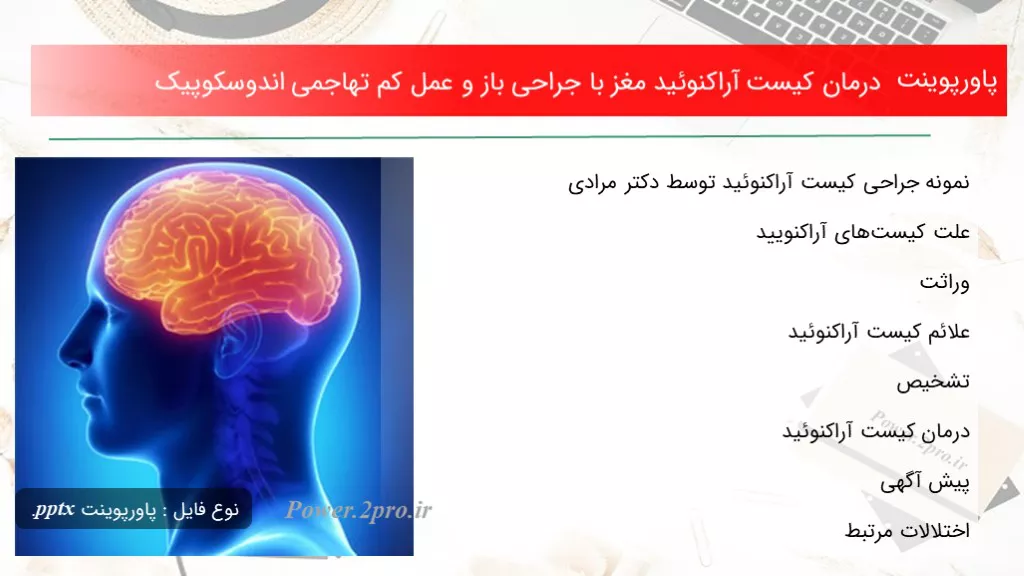 دانلود پاورپوینت درمان کیست آراکنوئید مغز با جراحی باز و عمل کم تهاجمی اندوسکوپیک - کد100409