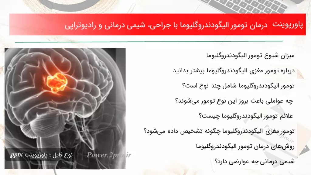 دانلود پاورپوینت درمان تومور الیگودندروگلیوما با جراحی، شیمی درمانی و رادیوتراپی - کد100413