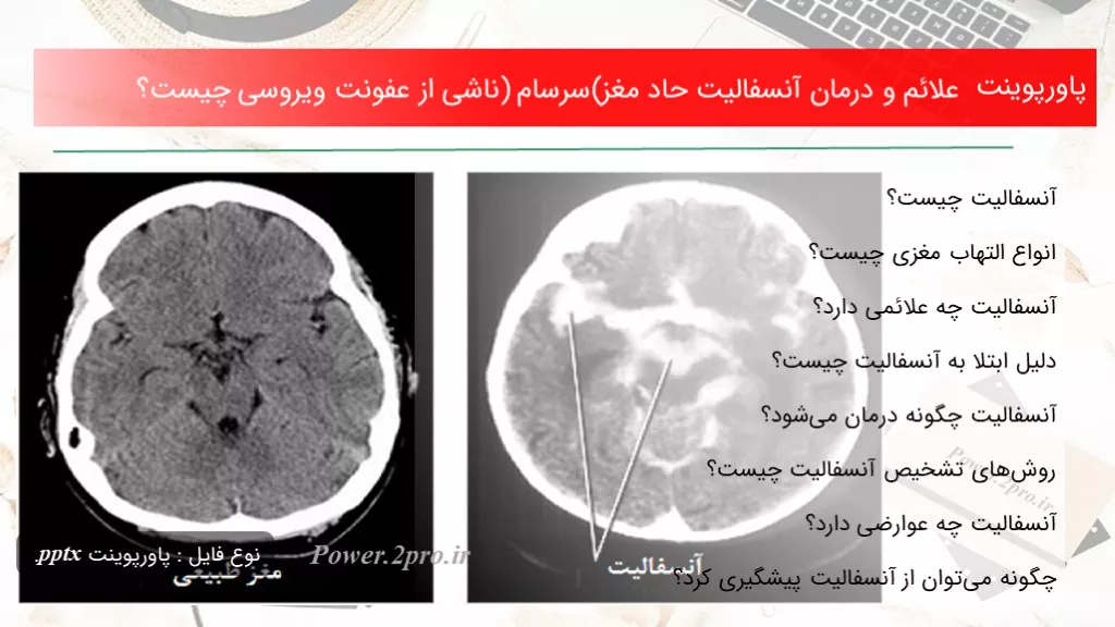 دانلود پاورپوینت علائم و درمان آنسفالیت حاد مغز(سرسام) ناشی از عفونت ویروسی چه چیزی است ؟ - کد100441