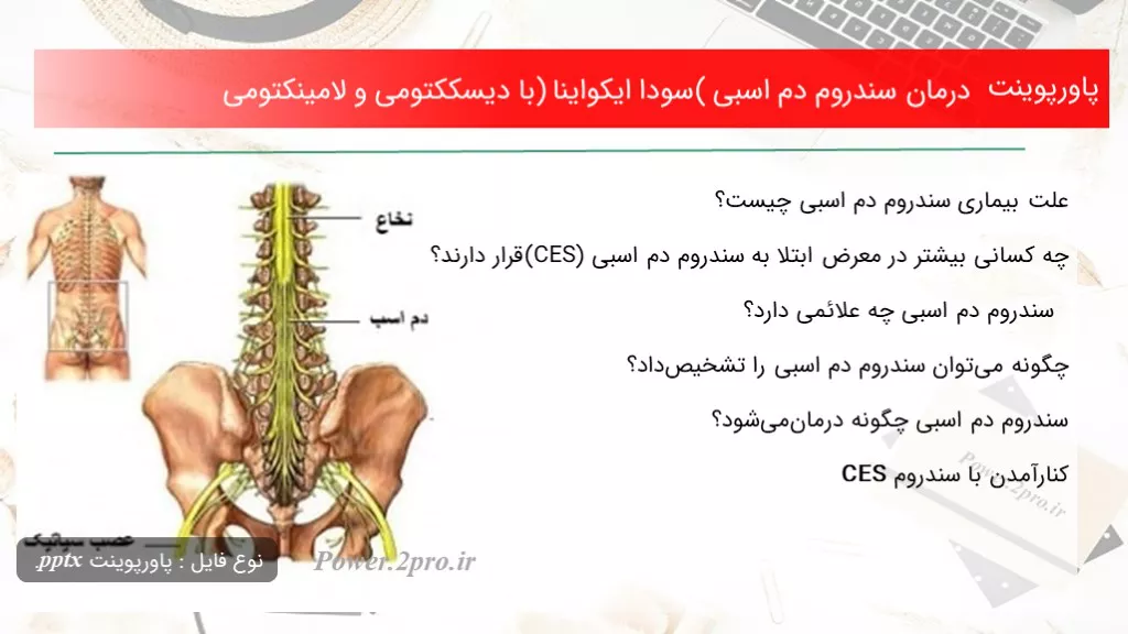 دانلود پاورپوینت درمان سندروم دم اسبی (سودا ایکواینا) با دیسککتومی و لامینکتومی - کد100452