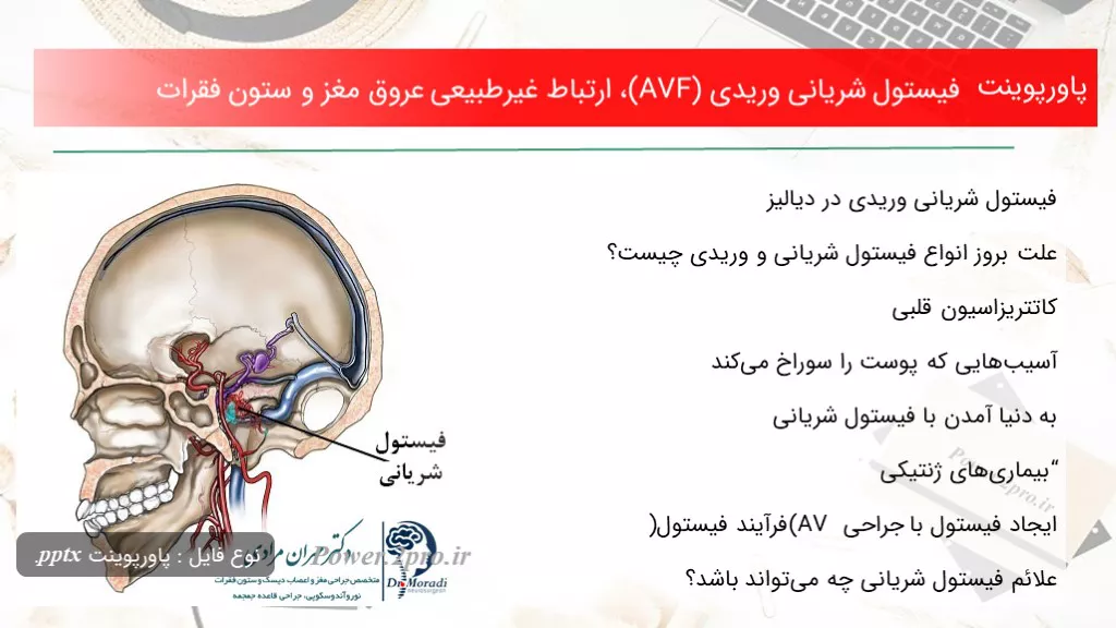 دانلود پاورپوینت فیستول شریانی وریدی (AVF)، بستگی غیرطبیعی عروق مغز و ستون فقرات - کد100453