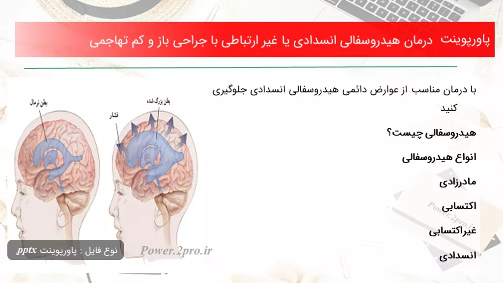 دانلود پاورپوینت درمان هیدروسفالی انسدادی یا غیر ارتباطی با جراحی باز و کم تهاجمی - کد100454