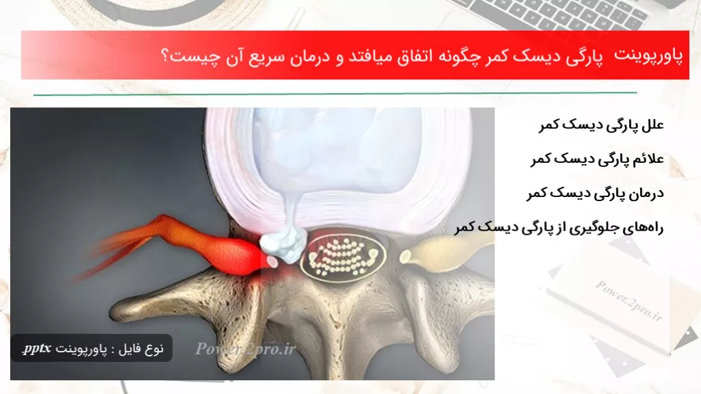 دانلود پاورپوینت پارگی دیسک کمر چطور اتفاق میافتد و درمان سریع آن چه چیزی است ؟ - کد100468