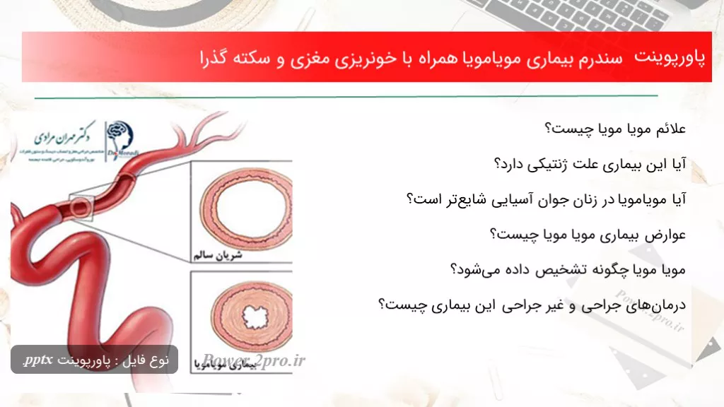 دانلود پاورپوینت سندرم بیماری مویامویا همراه با خونریزی مغزی و سکته گذرا - کد100483