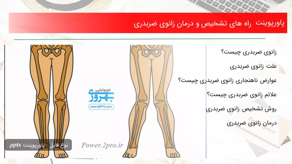 دانلود پاورپوینت راه های تشخیص و درمان زانوی ضربدری - کد100564