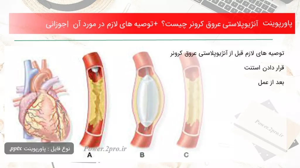 دانلود پاورپوینت آنژیوپلاستی عروق کرونر چه چیزی است ؟ + توصیه های لازم در ضمینه آن | جوزانی - کد101207