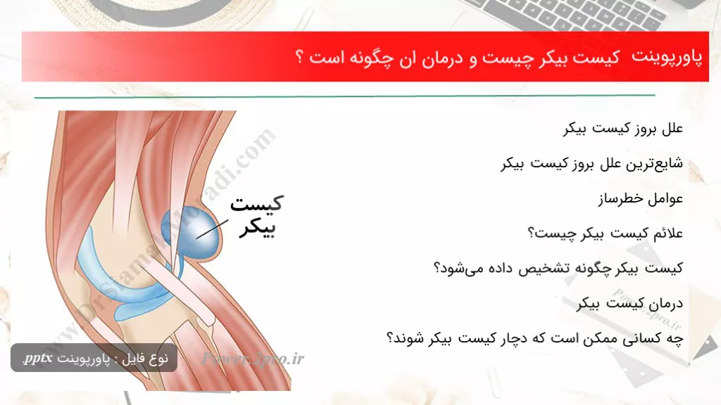 دانلود پاورپوینت کیست بیکر چه چیزی است و درمان ان چطور است ؟ - کد101239