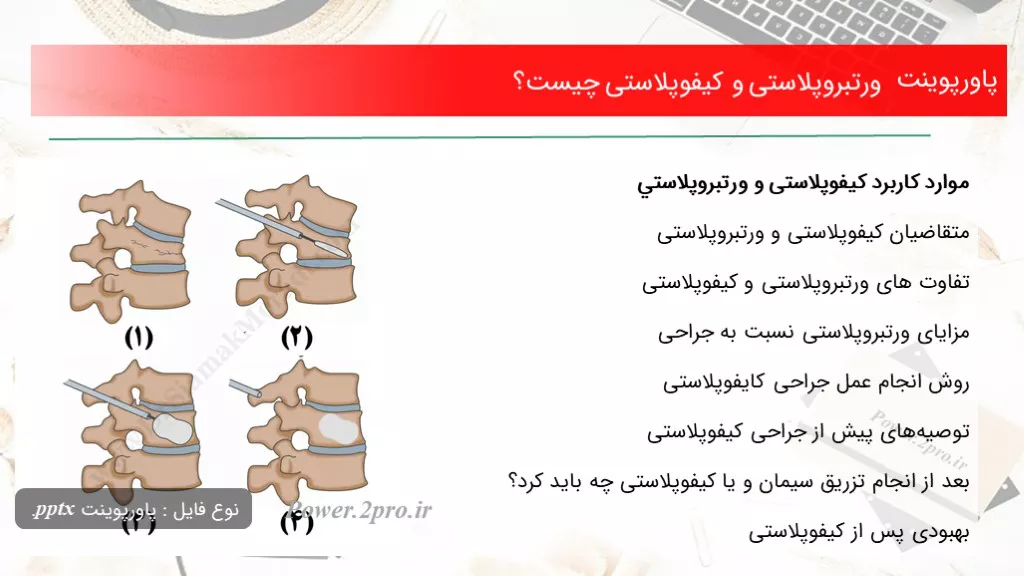 دانلود پاورپوینت ورتبروپلاستی و كيفوپلاستی چه چیزی است ؟ - کد101278