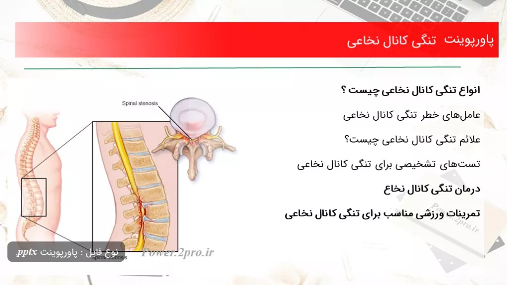 دانلود پاورپوینت تنگی کانال نخاعی - کد101297