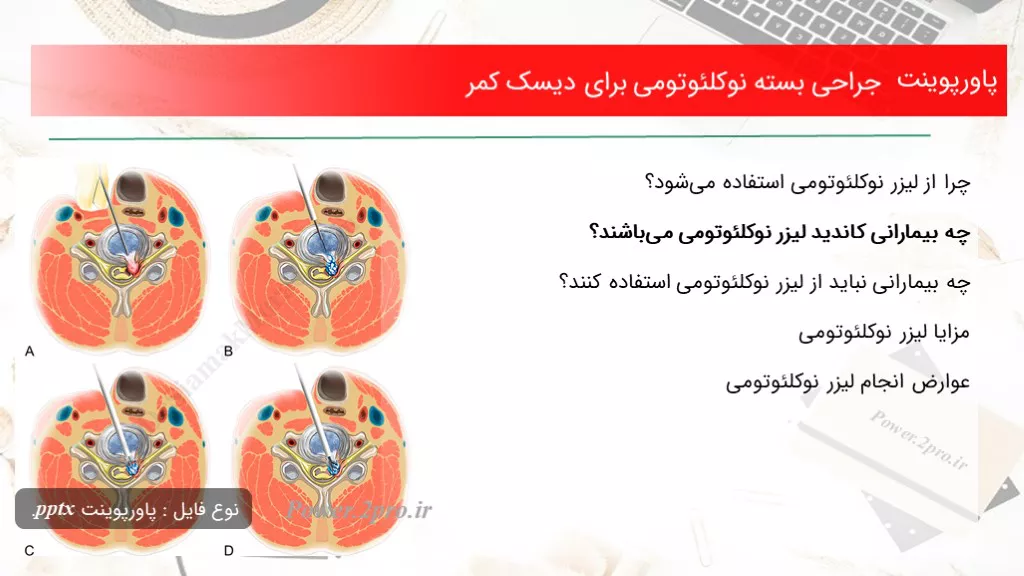 دانلود پاورپوینت جراحی بسته نوکلئوتومی به منظور دیسک کمر - کد101301