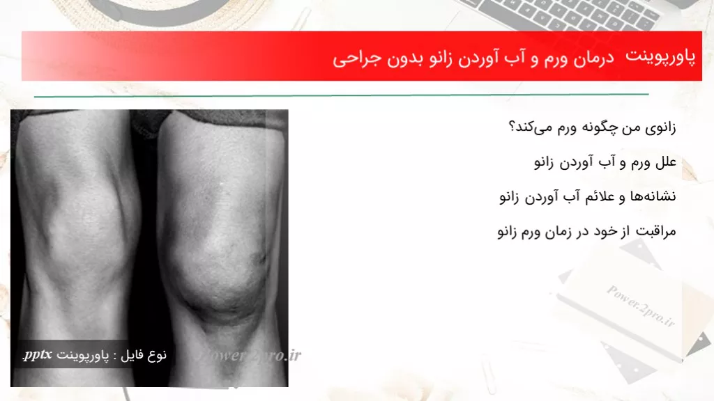 دانلود پاورپوینت درمان ورم و آب آوردن زانو بدون جراحی - کد101337