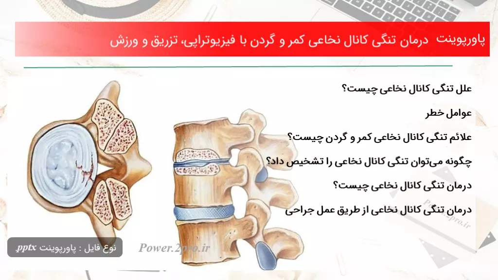 دانلود پاورپوینت درمان تنگی کانال نخاعی کمر و گردن با فیزیوتراپی، تزریق و ورزش - کد101367