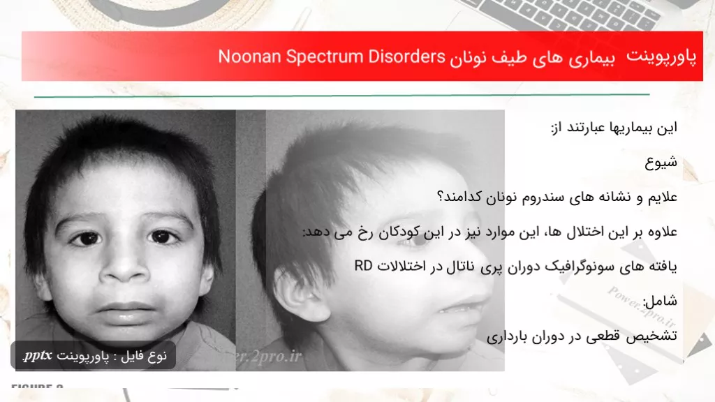 دانلود پاورپوینت بیماری های طیف نونان Noonan Spectrum Disorders - کد101477