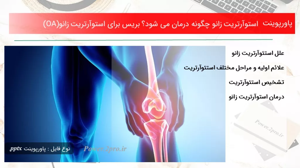 دانلود پاورپوینت استوآرتریت زانو چطور درمان می شود؟ بریس به منظور استوآرتریت زانو(OA) - کد101515