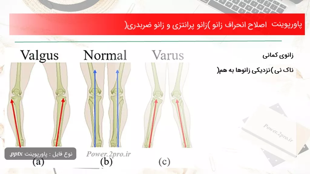 دانلود پاورپوینت اصلاح انحراف زانو (زانو پرانتزی و زانو ضربدری) - کد101518