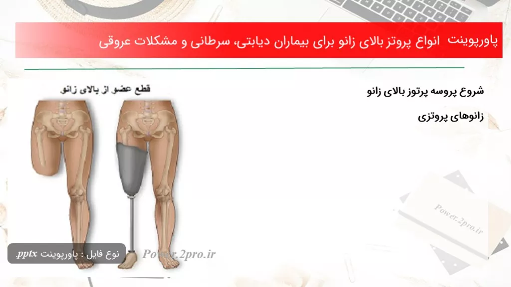 دانلود پاورپوینت انواع پروتز بالای زانو به منظور بیماران دیابتی، سرطانی و مشکلات عروقی - کد101528