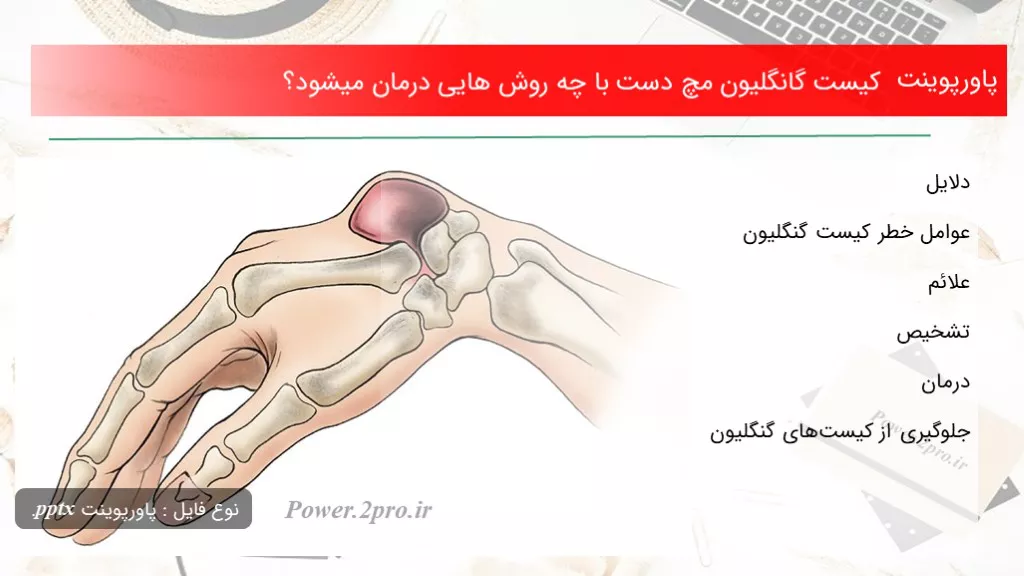 دانلود پاورپوینت کیست گانگلیون مچ دست با چه چگونگی هایی درمان میشود؟ - کد101681