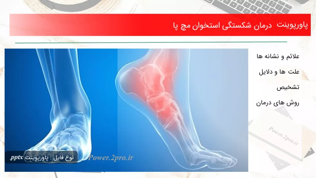 دانلود پاورپوینت درمان شکستگی استخوان مچ پا - کد101693