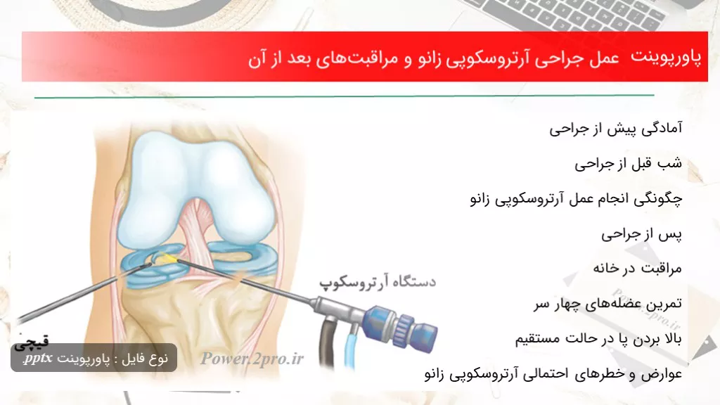 دانلود پاورپوینت عمل جراحی آرتروسکوپی زانو و مراقبت‌های بعد از آن - کد101759