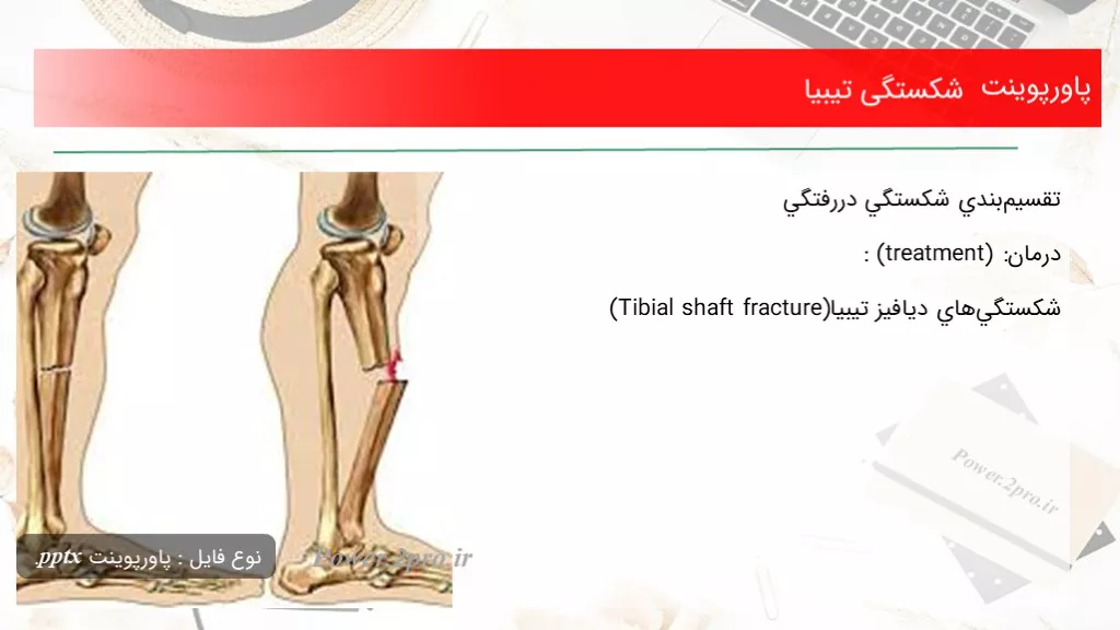 دانلود پاورپوینت شکستگی تیبیا - کد101810