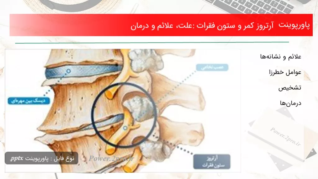 دانلود پاورپوینت آرتروز کمر و ستون فقرات: چرایی ، علائم و درمان - کد101846