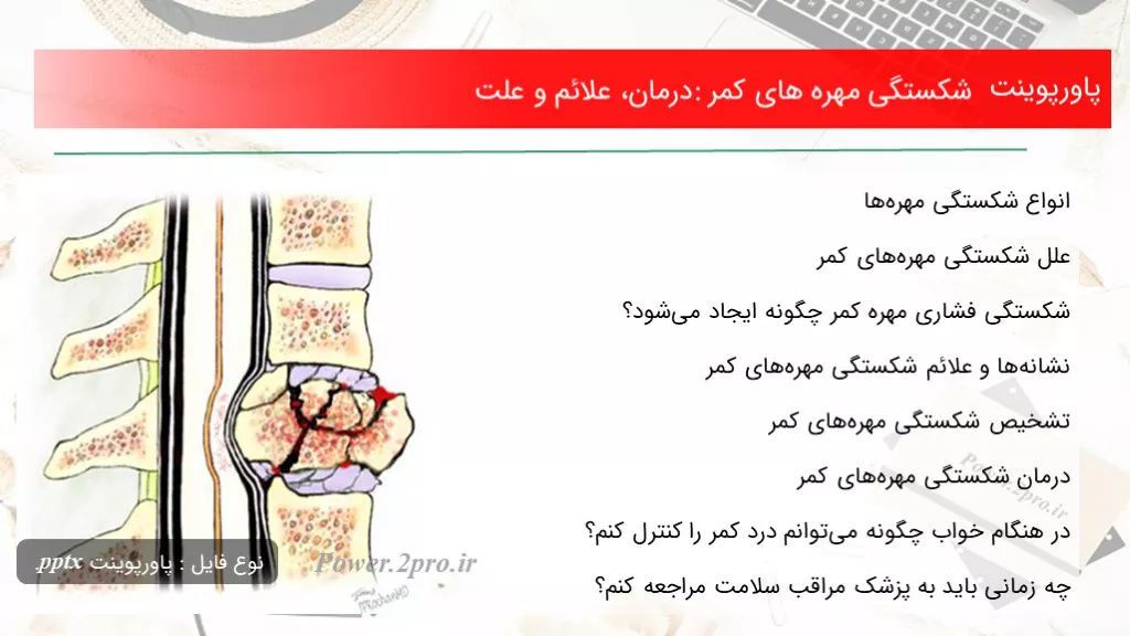 دانلود پاورپوینت شکستگی مهره های کمر: درمان، علائم و چرایی - کد101900