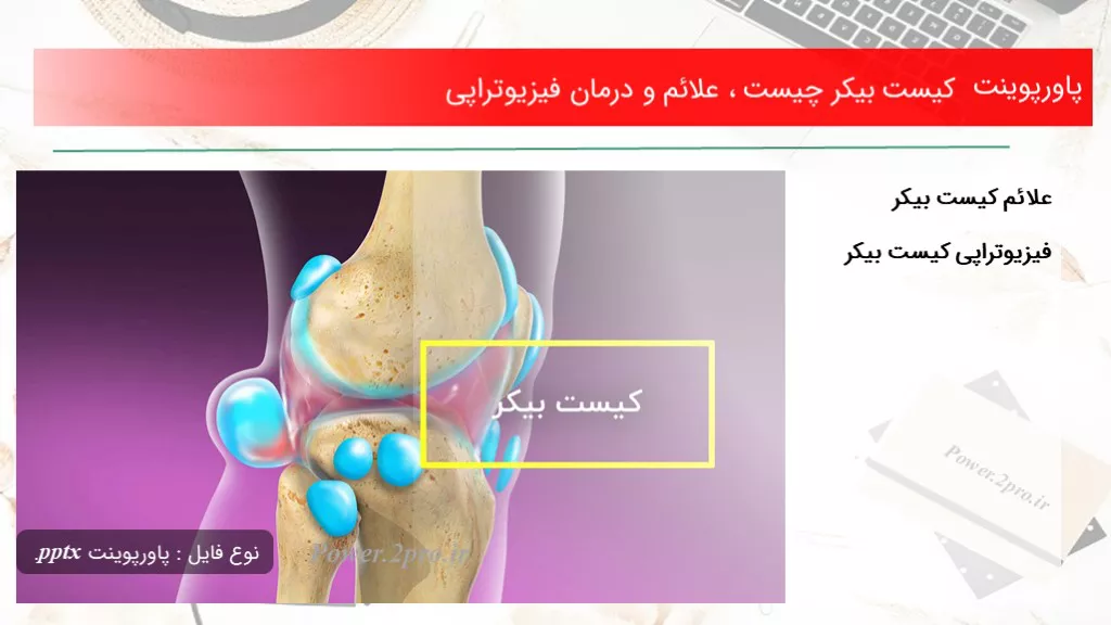 دانلود پاورپوینت کیست بیکر چه چیزی است ، علائم و درمان فیزیوتراپی - کد102288