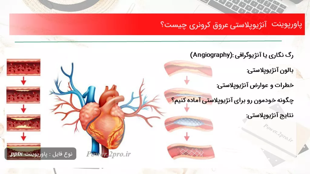 دانلود پاورپوینت آنژیوپلاستی عروق کرونری چه چیزی است ؟ - کد102481