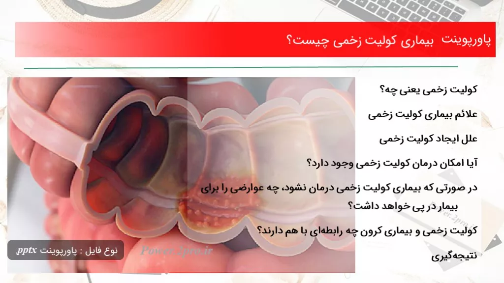 دانلود پاورپوینت بیماری کولیت زخمی چه چیزی است ؟ - کد102640