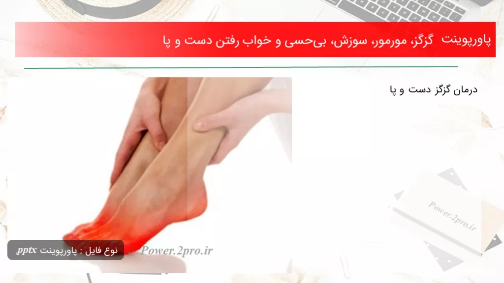 دانلود پاورپوینت گزگز، مورمور، سوزش، بی‌حسی و خواب رفتن دست و پا - کد105050