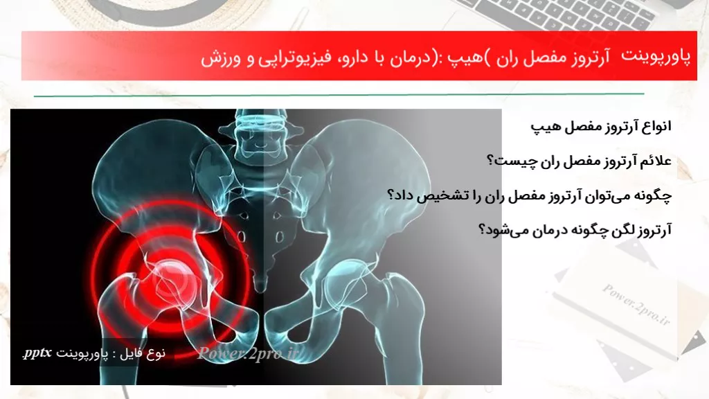 دانلود پاورپوینت آرتروز مفصل ران (هیپ): درمان با دارو، فیزیوتراپی و ورزش - کد105069