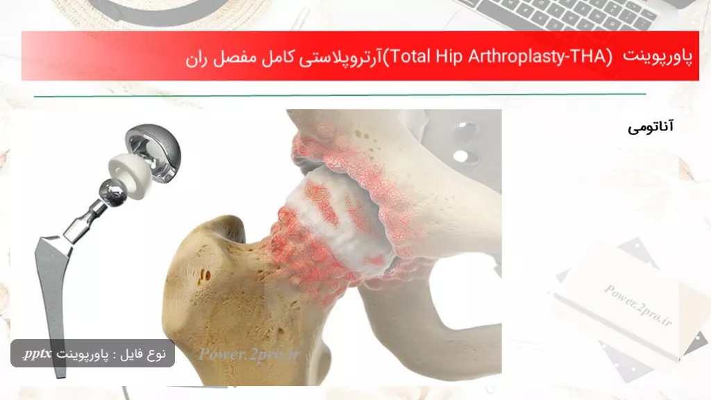 دانلود پاورپوینت (Total Hip Arthroplasty-THA)آرتروپلاستی کامل مفصل ران - کد105101