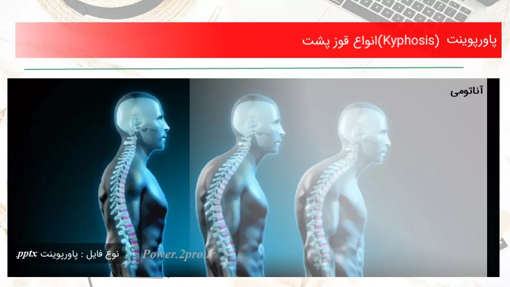 دانلود پاورپوینت (Kyphosis)انواع قوز پشت - کد105105