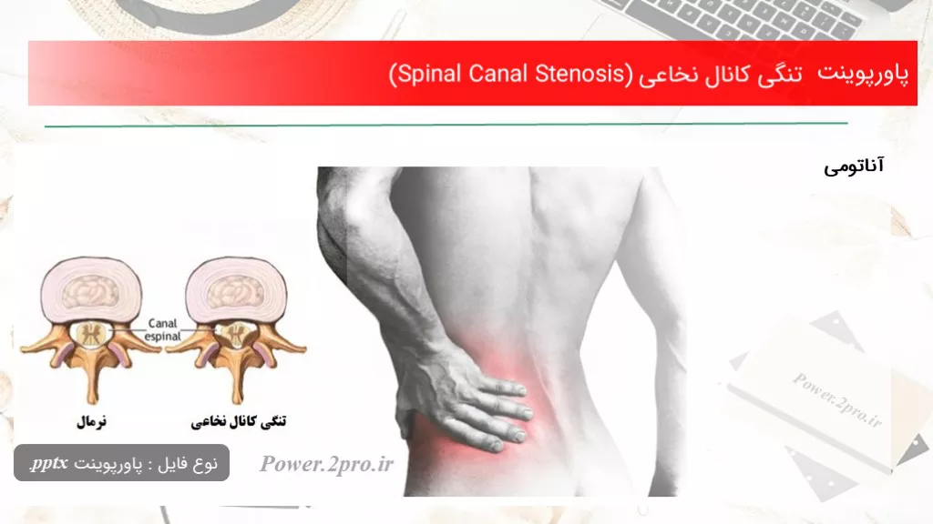 تنگی کانال نخاعی (Spinal Canal Stenosis)