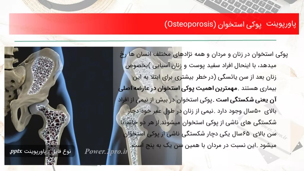 دانلود پاورپوینت پوکی استخوان (Osteoporosis) - کد105146