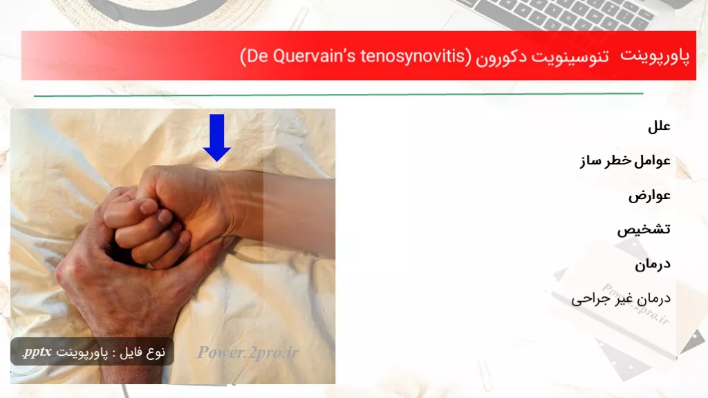 دانلود پاورپوینت تنوسینویت دکورون (De Quervain’s tenosynovitis) - کد105147