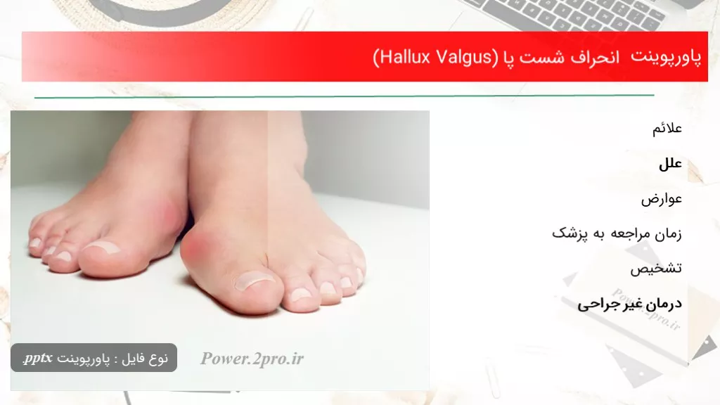 دانلود پاورپوینت انحراف شست پا (Hallux Valgus) - کد105148