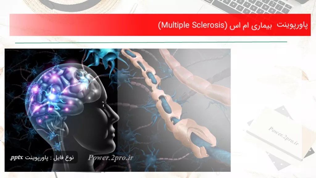 دانلود پاورپوینت بیماری ام اس(Multiple Sclerosis)  - کد105156