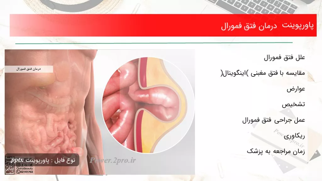 دانلود پاورپوینت درمان فتق فمورال - کد107049