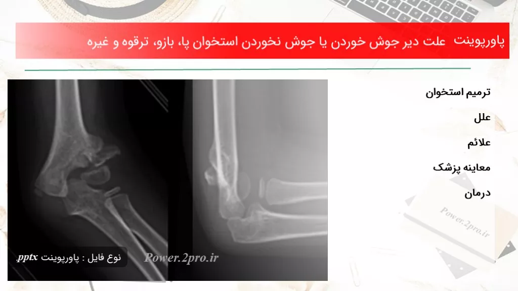 دانلود پاورپوینت چرایی دیر جوش خوردن یا جوش نخوردن استخوان پا، بازو، ترقوه و غیره - کد107803