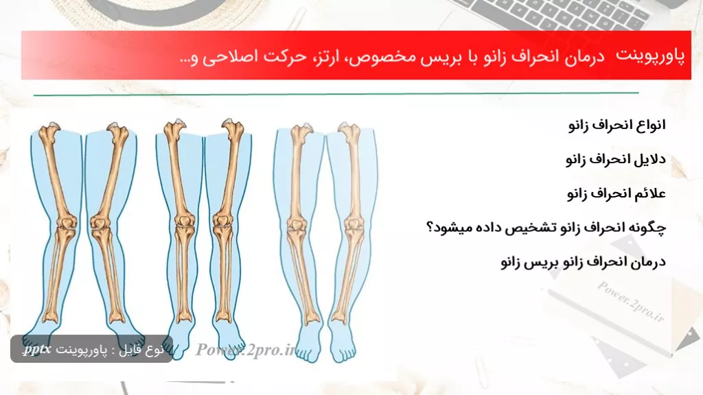 دانلود پاورپوینت درمان انحراف زانو با بریس مخصوص، ارتز، حرکت اصلاحی و… - کد107838