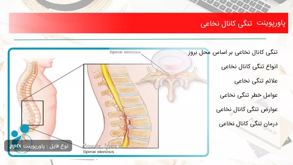 دانلود پاورپوینت تنگی کانال نخاعی - کد107889