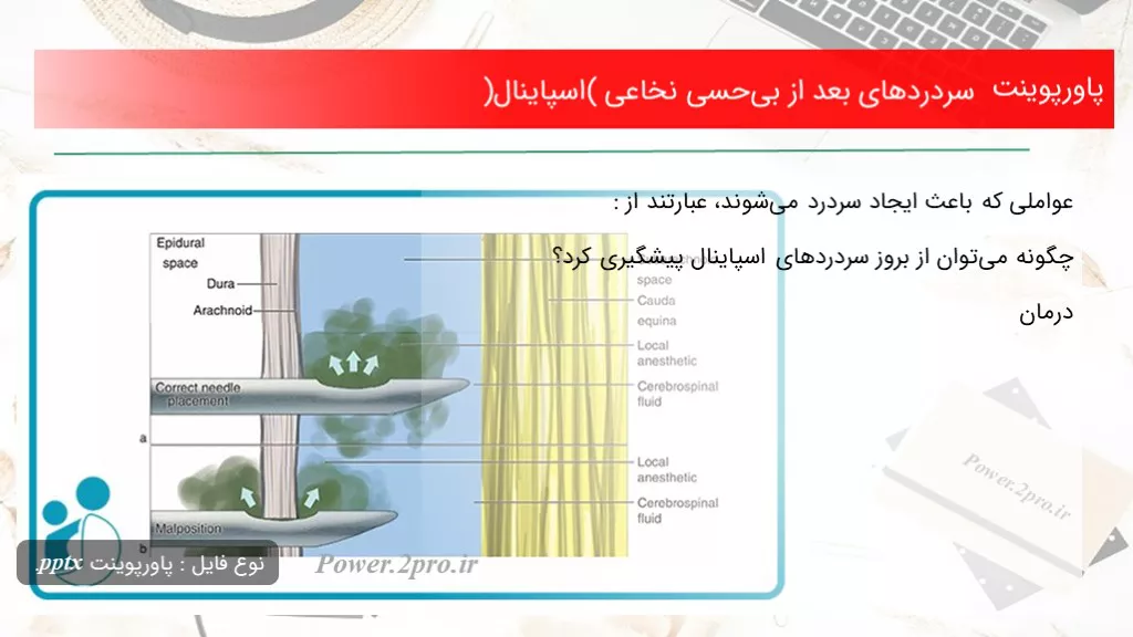 دانلود پاورپوینت سردردهای بعد از بی‌حسی نخاعی (اسپاینال) - کد107902