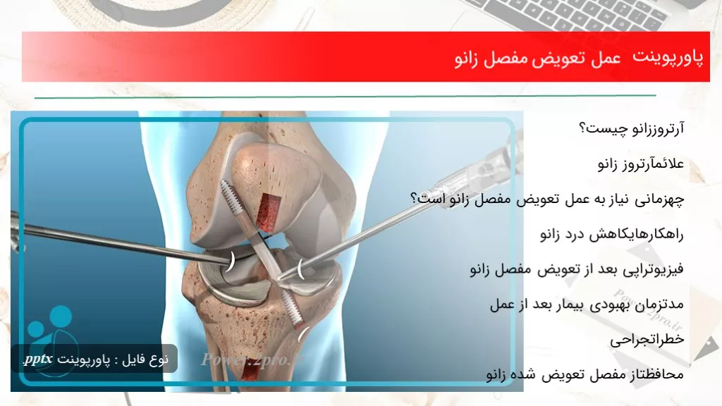 دانلود پاورپوینت عمل تعویض مفصل زانو - کد107904