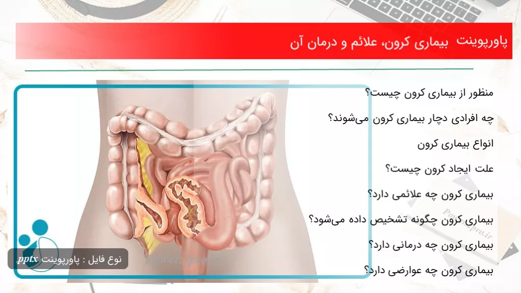 دانلود پاورپوینت بیماری کرون، علائم و درمان آن - کد107927