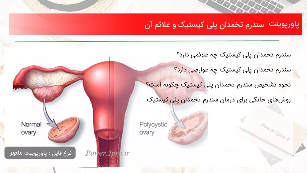 سندرم تخمدان پلی کیستیک و علائم آن