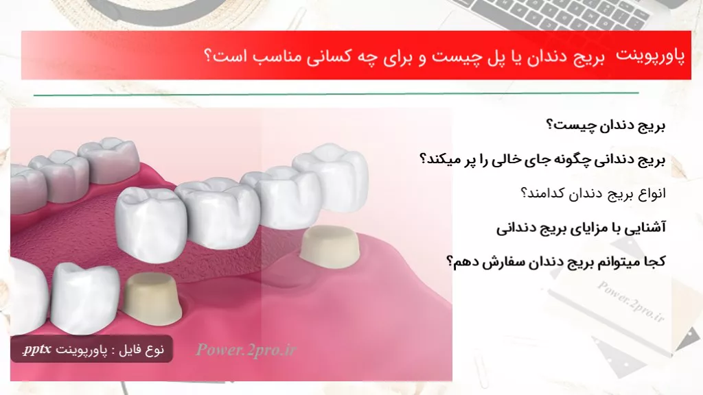 بریج دندان یا پل چیست و برای چه کسانی مناسب است؟