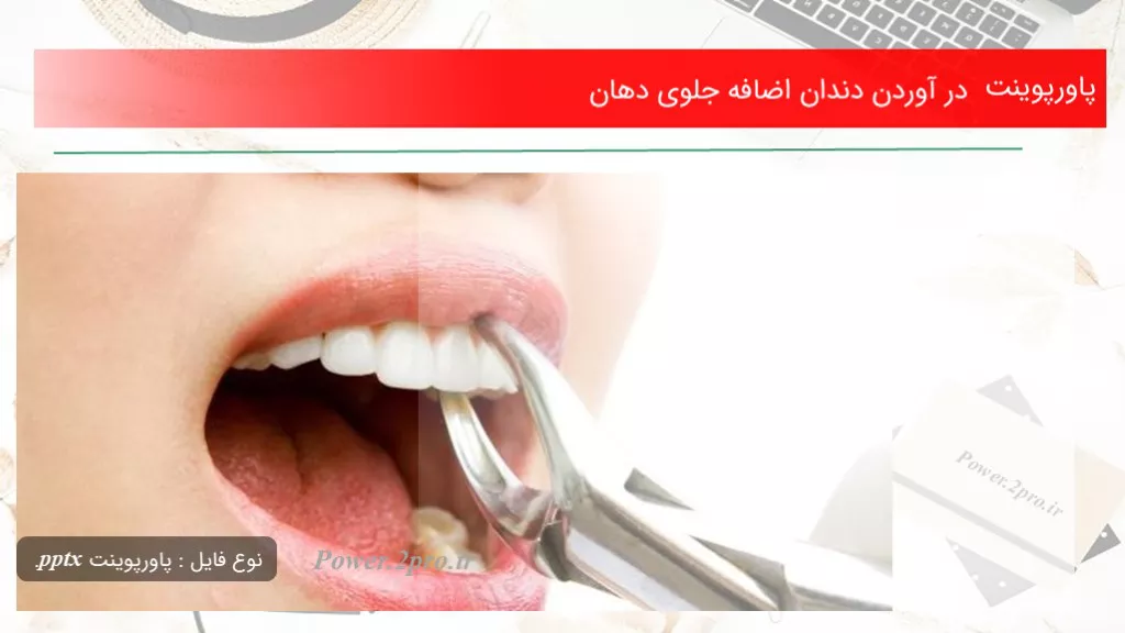 دانلود پاورپوینت در آوردن دندان اضافه جلوی دهان - کد107988