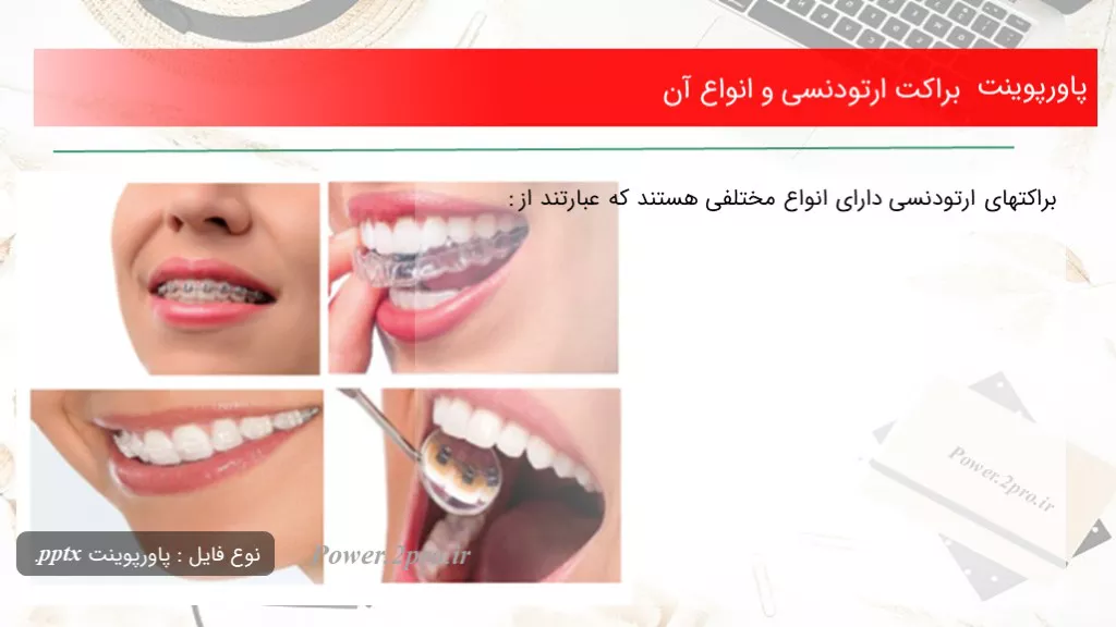 دانلود پاورپوینت براکت ارتودنسی و انواع آن - کد107992